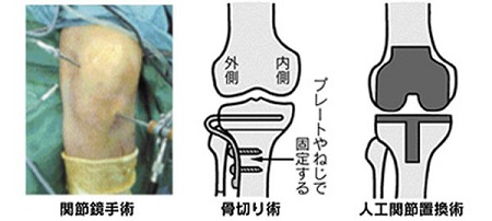 変形性膝関節症の手術